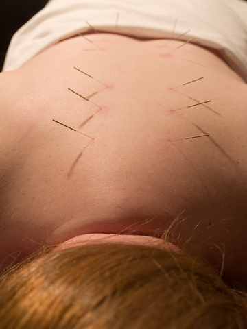 Back acupuncture as part of acupuncture fertility treatment